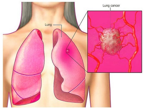 Lung Cancer